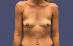 Breast Augmentation 25 Before